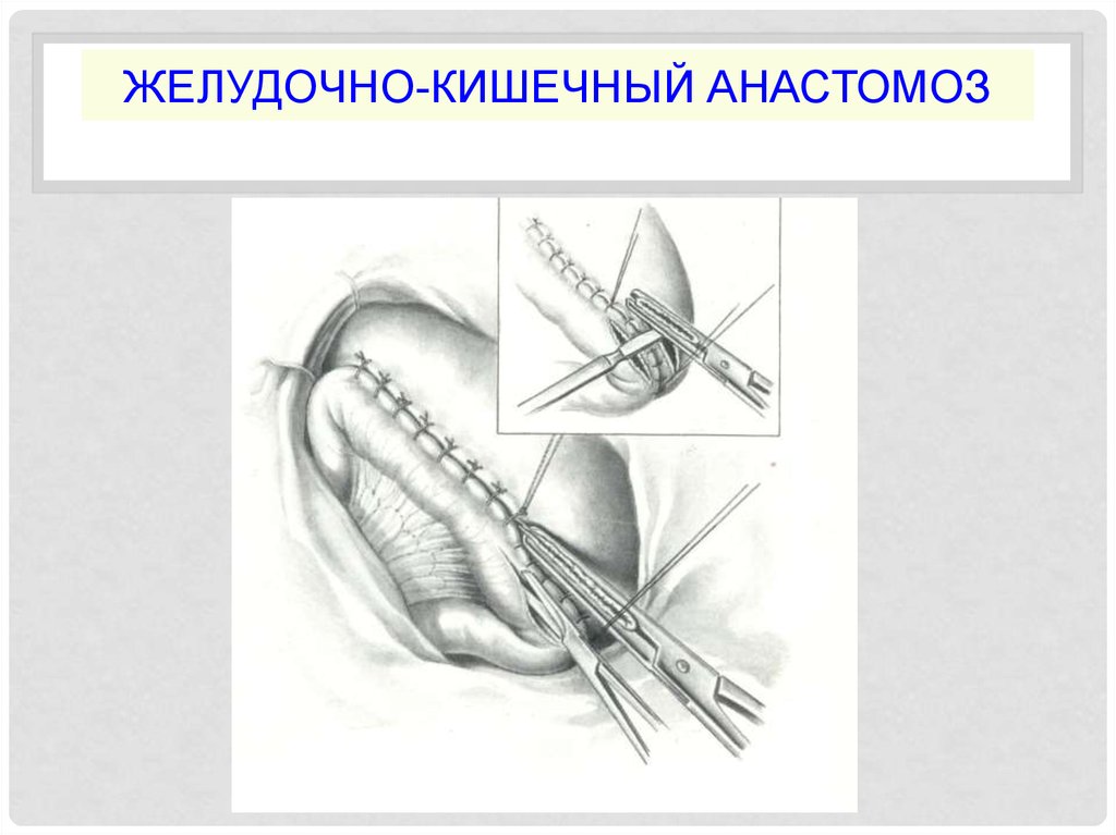 Кишечные анастомозы. Обходной анастомоз по Брауну. Желудочно кишечные соустья. Операция наложения желудочно-кишечного анастомоза. Анастомоз по Брауну схема.