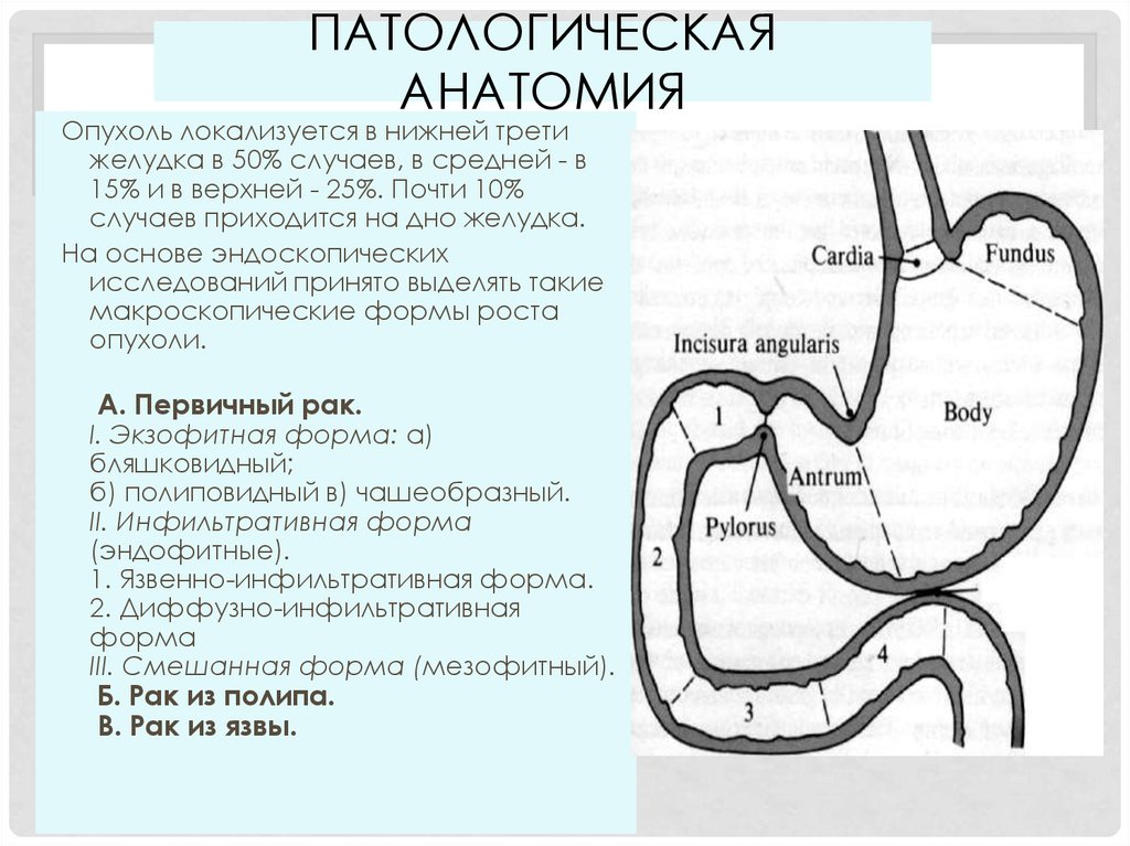 Тотальный желудка. Патологическая анатомия неоплазии желудка. Опухоли желудка патанатомия.