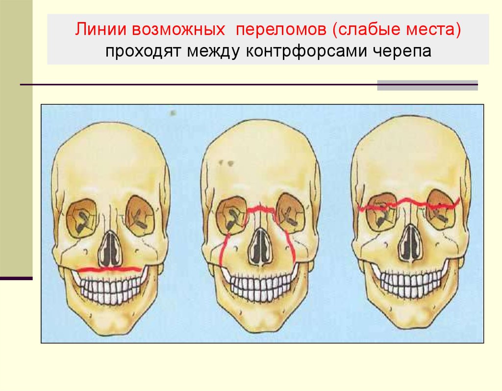 Перелом лицевого черепа. Контрфорсы черепа верхней челюсти. Контрфорсы костей лицевого черепа. Контрфорсы слабые места черепа.