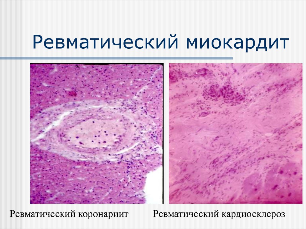 Эндокардит миокардит перикардит презентация