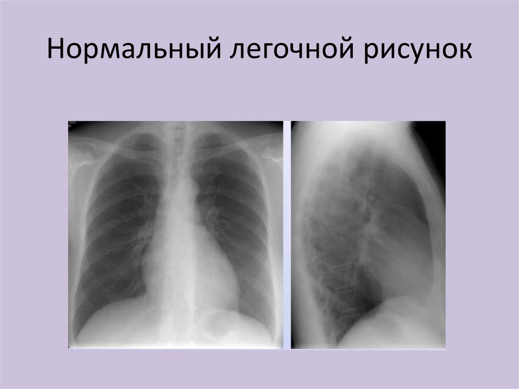 Легочно сосудистый рисунок усилен. Синдром изменения легочного рисунка рентген. Синдром обогащения легочного рисунка рентген. Изменение легочного рисунка. Обеднение легочного рисунка.