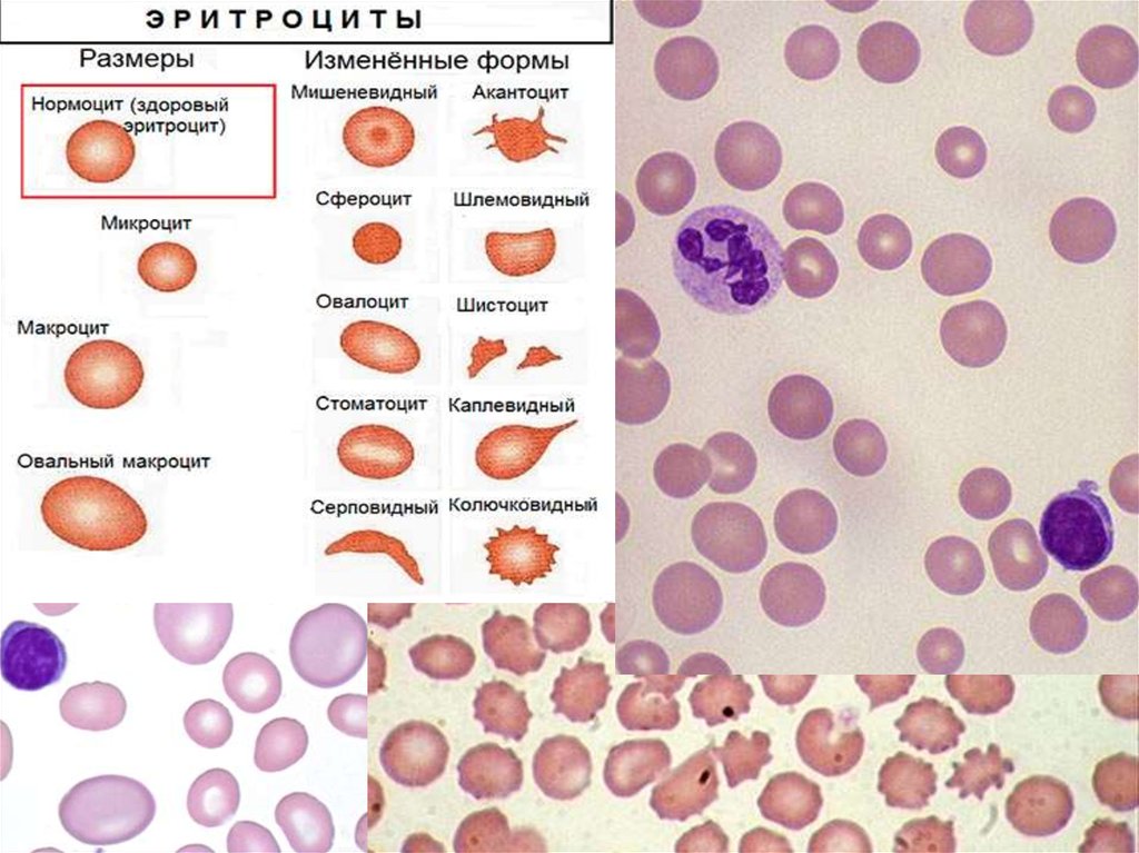 Макроциты. Полихроматофильный нормоцит. Эритроциты мишеневидной формы. Нормоцит микроцит макроцит. Овалоцит.