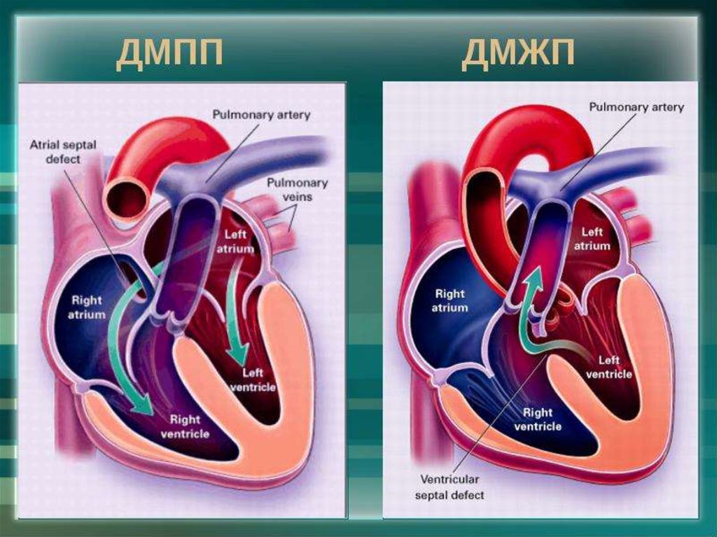 Дефект межжелудочковой перегородки фото