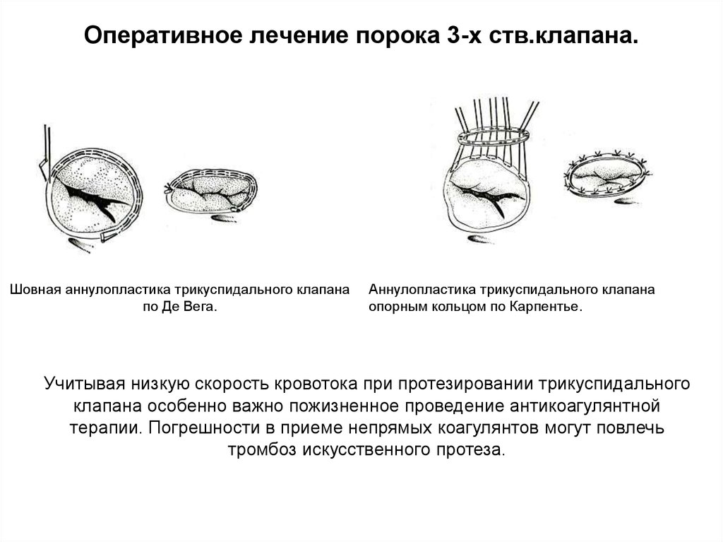 Пластика трикуспидального клапана