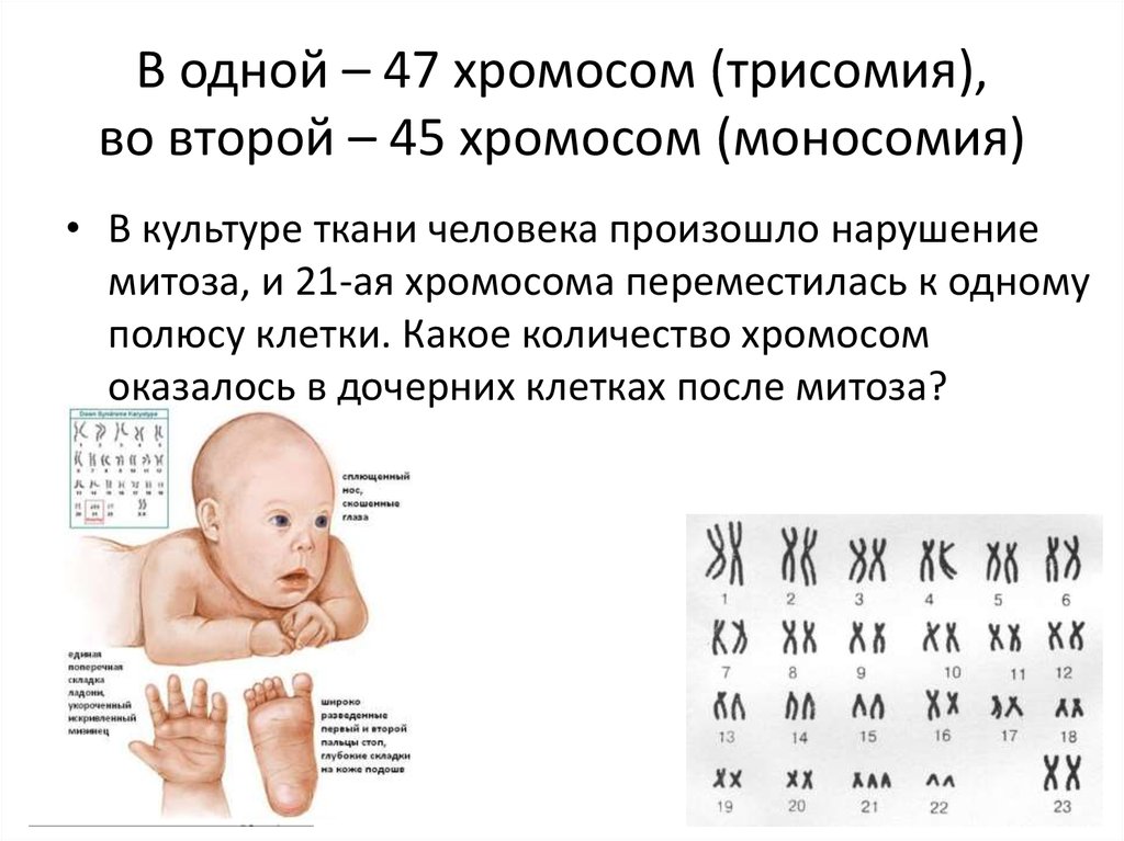 Пересадка хромосом. Синдром Патау (трисомия 13-й хромосомы). Синдром Эдвардса характеристика кариотипа. Моносомия хромосомы 2 у мальчиков.