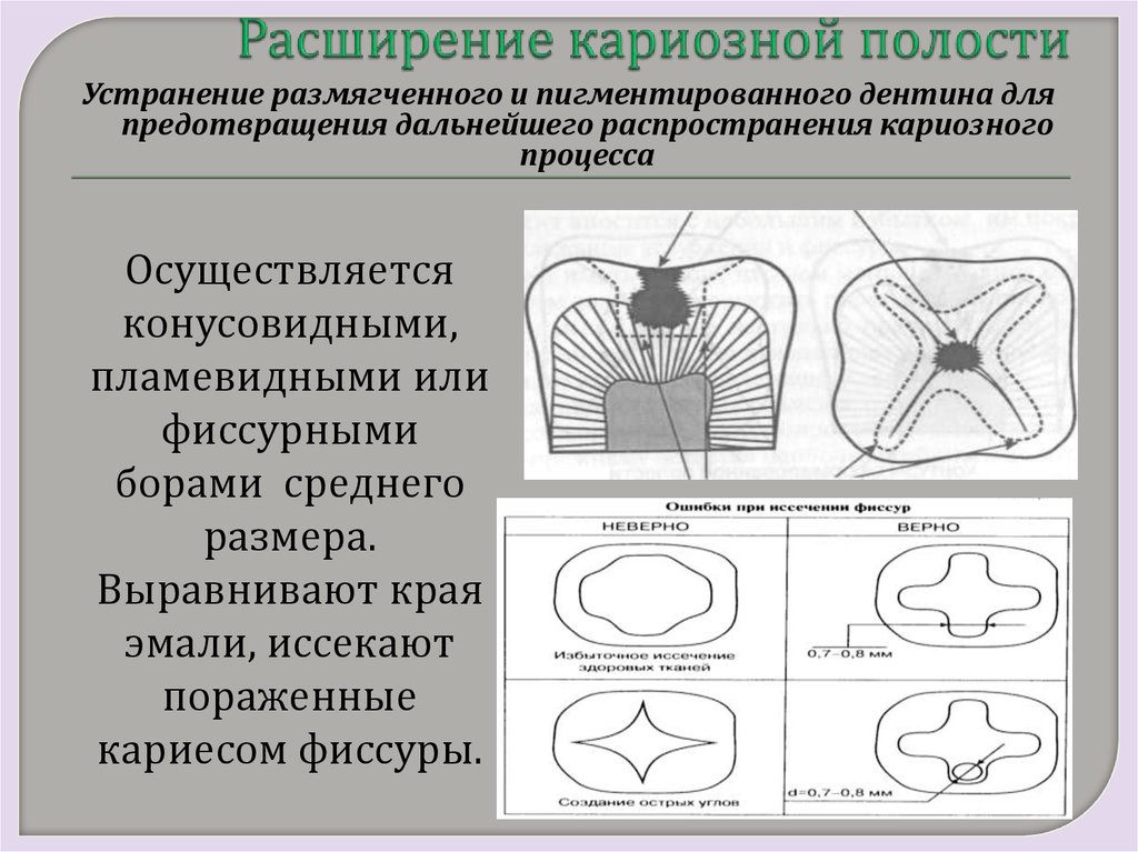 Пломбирование кариозных полостей по блэку