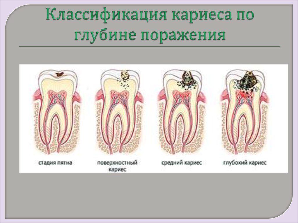 Классификация поражений зубов. Клинико-топографическая классификация кариеса. Топографическая классификация кариеса зубов. Классификация кариеса в зависимости от глубины поражения. Клиникотопогрвфияеская клссификация Кариема.