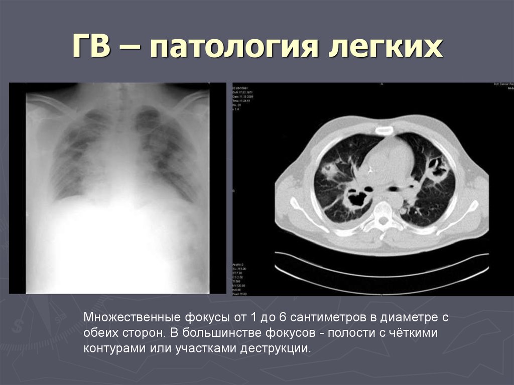 Патология легких. Гранулематоз Вегенера кт. Гранулематоз Вегенера кт легких. Гранулематоз Вегенера на кт лёгких.