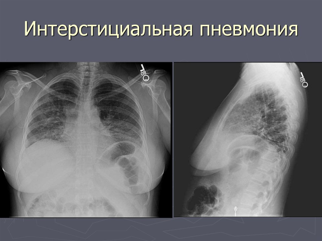 Рентген картина пневмонии