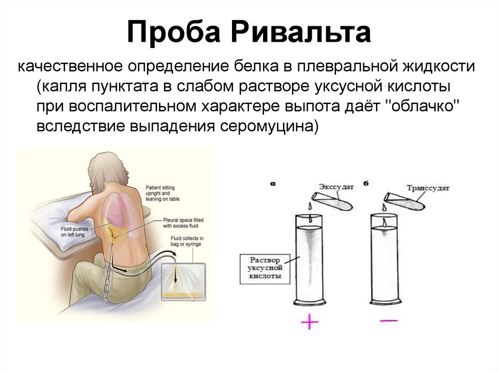 Реакция жидкость жидкость. Проба Ривальта методика. Проба Ривальта транссудат. Проба Ривольта в плевральной жидкости. Реакция Ривольта в плевральной жидкости положительная.