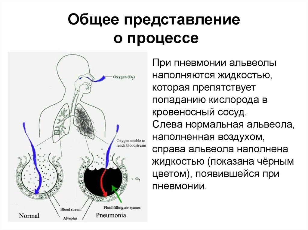 Основное представление. Общее представление о дыхании.. Общее представление о пневмонии. Общее представление.