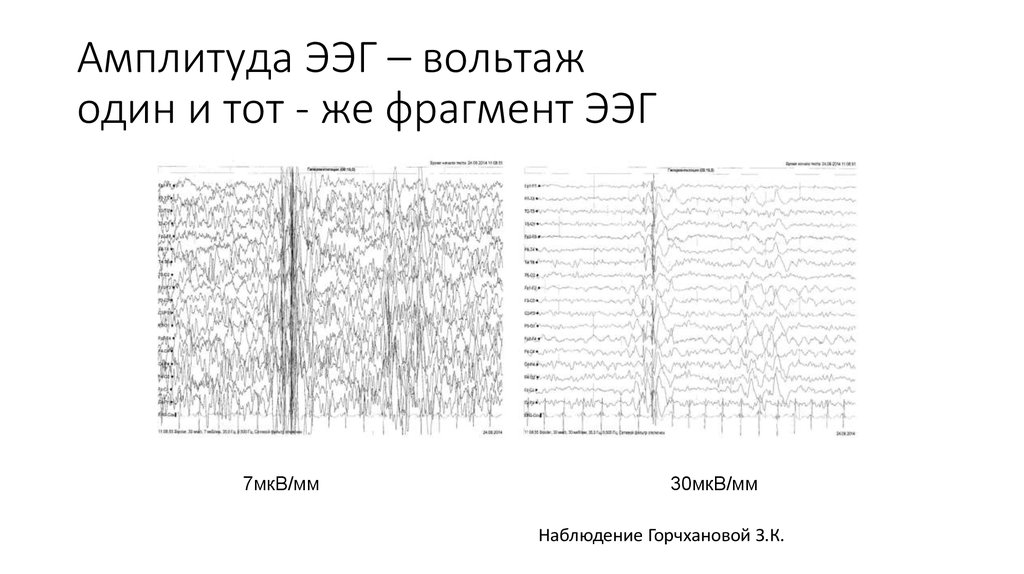 Эпилепсия на ээг фото