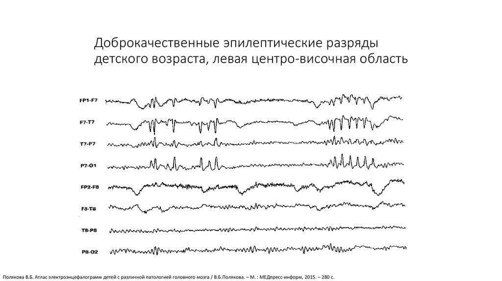 Серия эпиприступов карта вызова