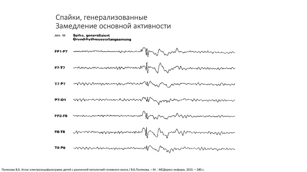 Спайки на ээг. Спайк волновая активность на ЭЭГ. Генерализованные Спайк волновые разряды на ЭЭГ. Спайки rectus lateralis на ЭЭГ. 6-14 Позитивные спайки на ЭЭГ.