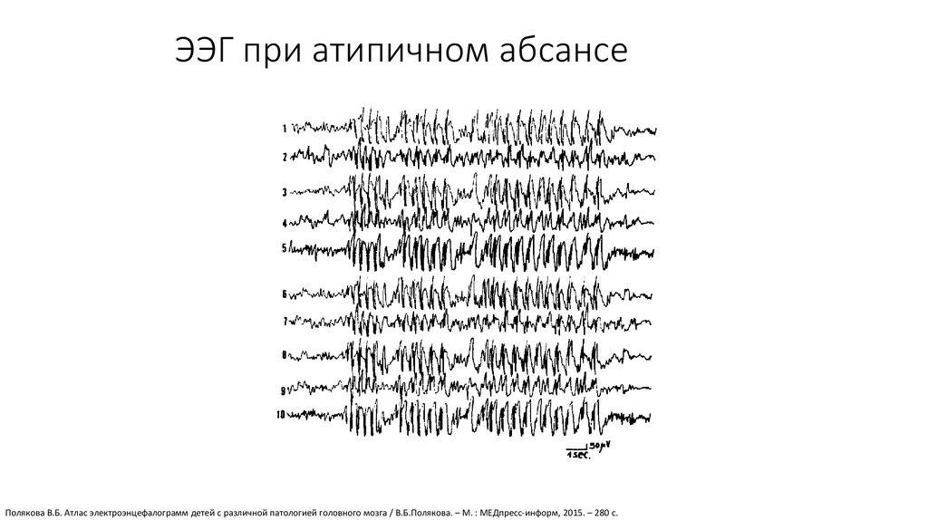 Ээг показывает эпилепсию. Атипичные абсансы на ЭЭГ. Абсансная эпилепсия на ЭЭГ. Детская абсансная эпилепсия на ЭЭГ. Паттерн абсанса на ЭЭГ.