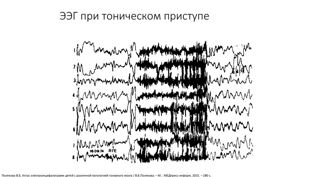 Ээг показывает эпилепсию. ЭЭГ головного мозга больного эпилепсией. ЭЭГ при эпилептическом припадке. Эпилептические паттерны на ЭЭГ. Иктальный паттерн на ЭЭГ при эпилепсии.