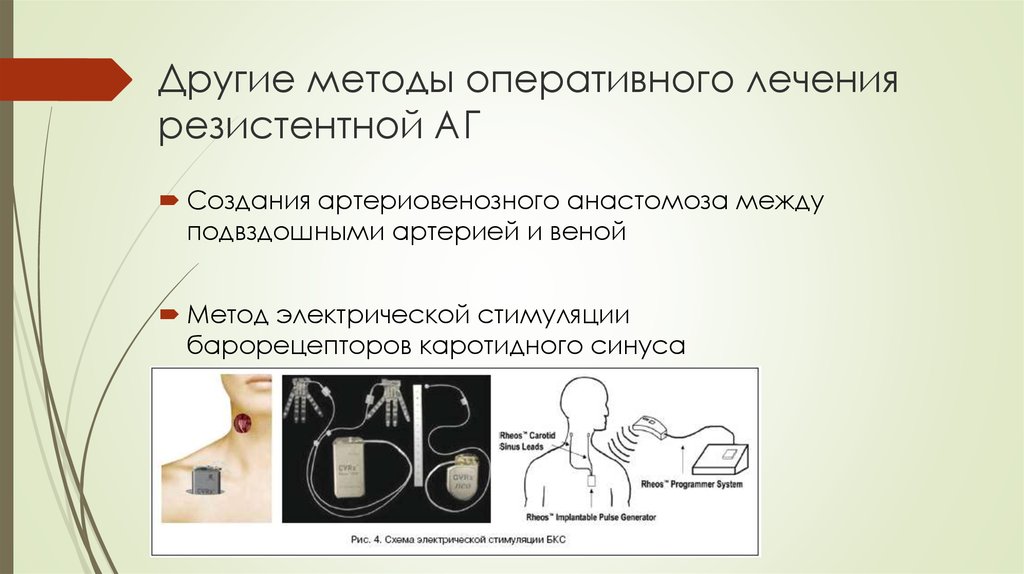 Метод оперативного. Стимуляция каротидного синуса. Стимуляция каротидного синуса вызывает. Стимуляция рецепторов каротидного синуса. Стимуляция барорецепторов каротидного синуса к чему приводит?.