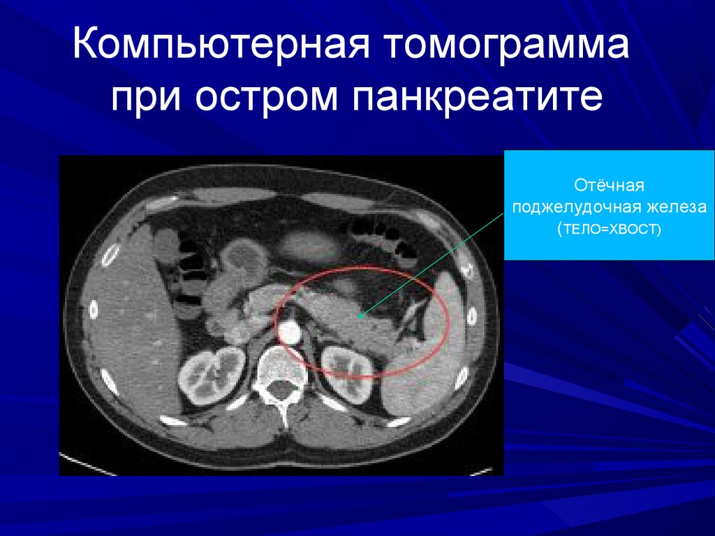 Образование поджелудочной железы. Образования поджелудочной железы на кт. Образование головки поджелудочной железы кт. Отделы поджелудочной железы кт. Образование тела поджелудочной железы кт.