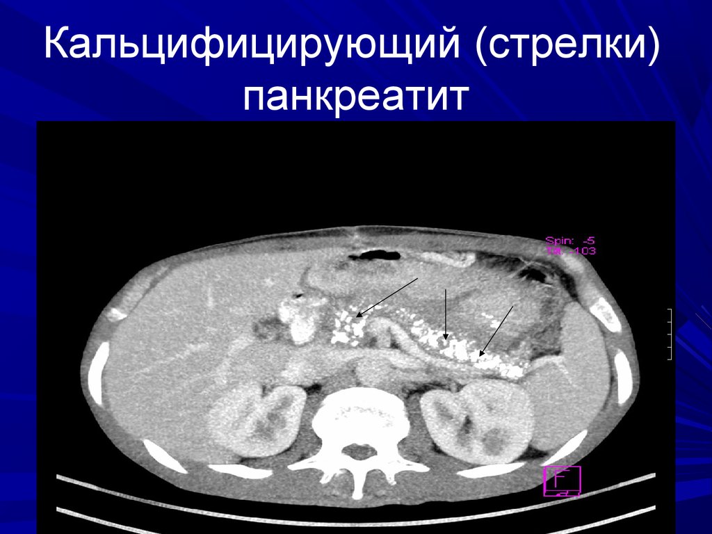 Кт картина панкреатита