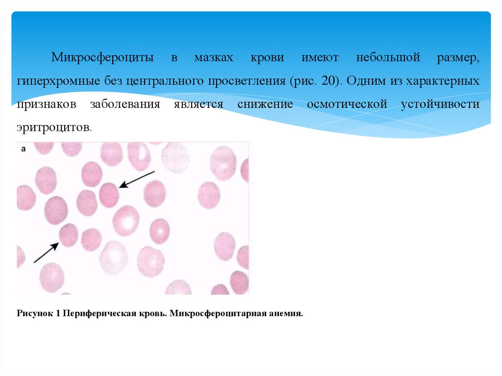 Эллиптоцитоз. Микросфероциты в крови. Наследственный овалоцитоз. Микросфероциты обнаруживаются в крови при. Микросфероцит и эритроцит.