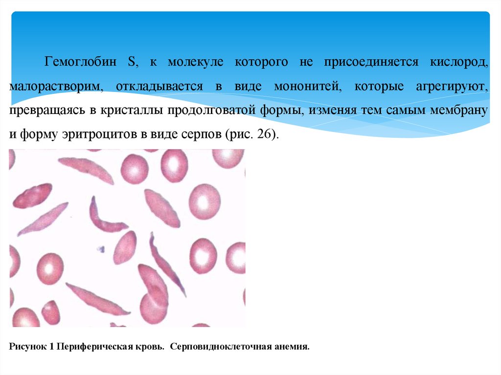 Серповидноклеточная анемия. Серповидноклеточная анемия карта. Серповидноклеточная анемия мазок. Серповидноклеточная анемия гемоглобин s.