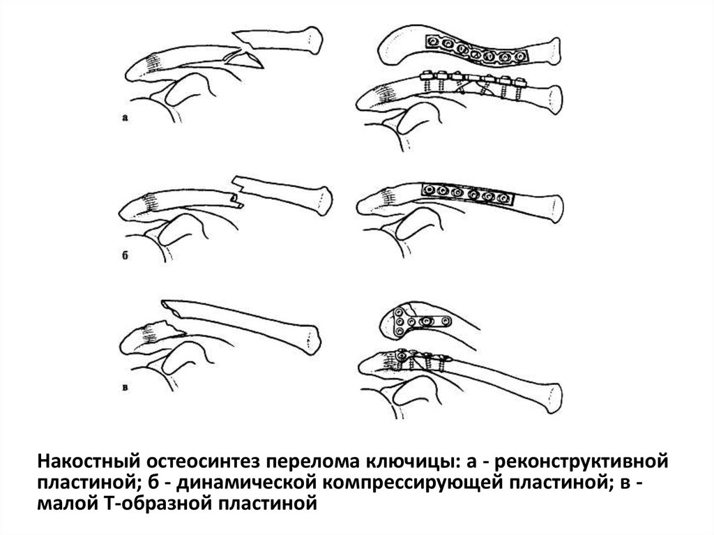 Травма ключицы карта вызова