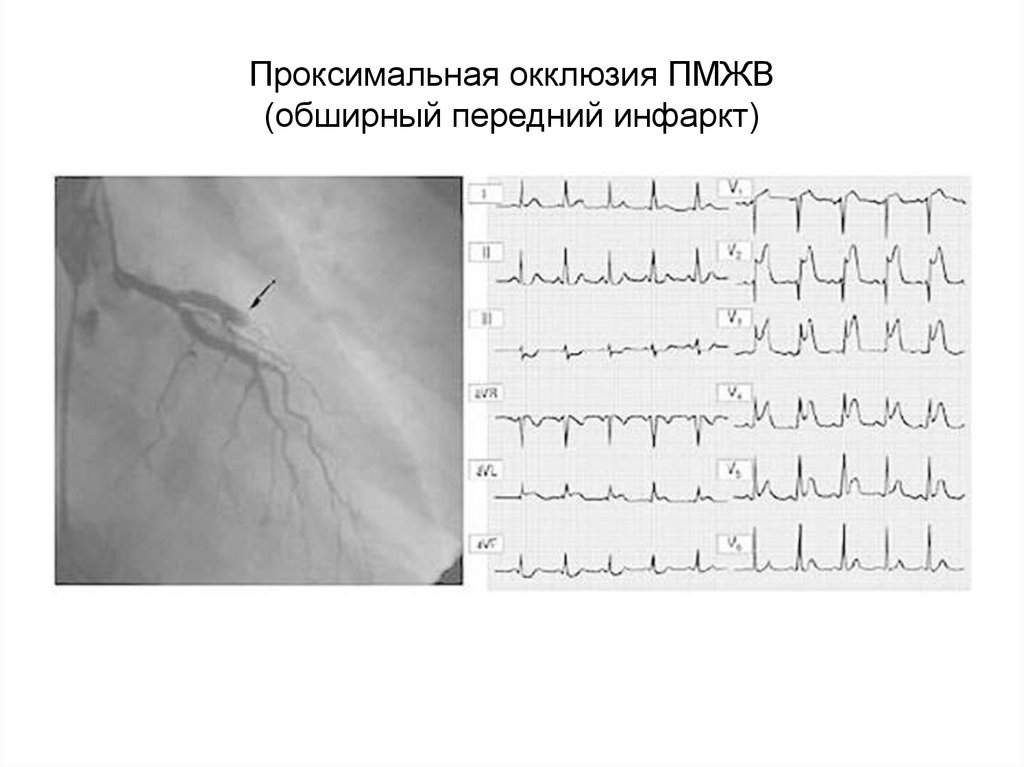 Коронарная окклюзия. Окклюзия коронарной артерии на ЭКГ. Окклюзия ствола лка ЭКГ. Проксимальная окклюзия ПМЖВ. ЭКГ при окклюзии ствола.