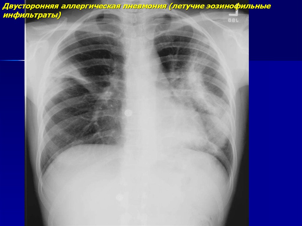 Эозинофильная пневмония презентация