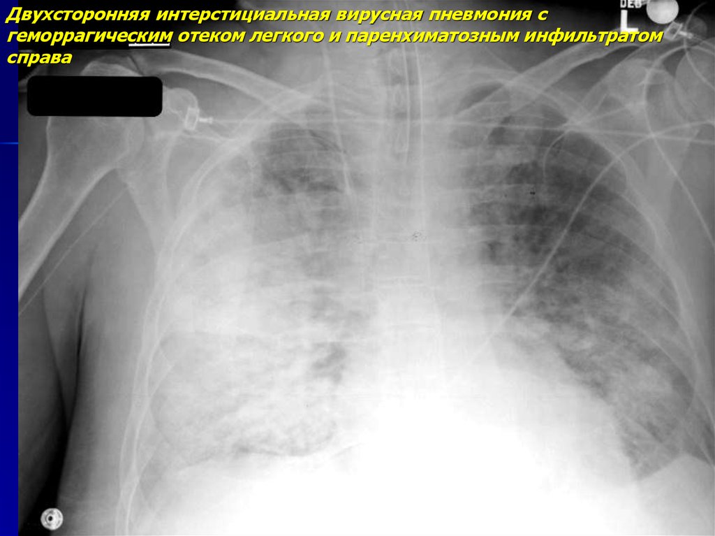 Интерстициальная пневмония рентген. Отек легкого на рентгенограмме. Отек легких рентген. Отёк лёгких рентген.