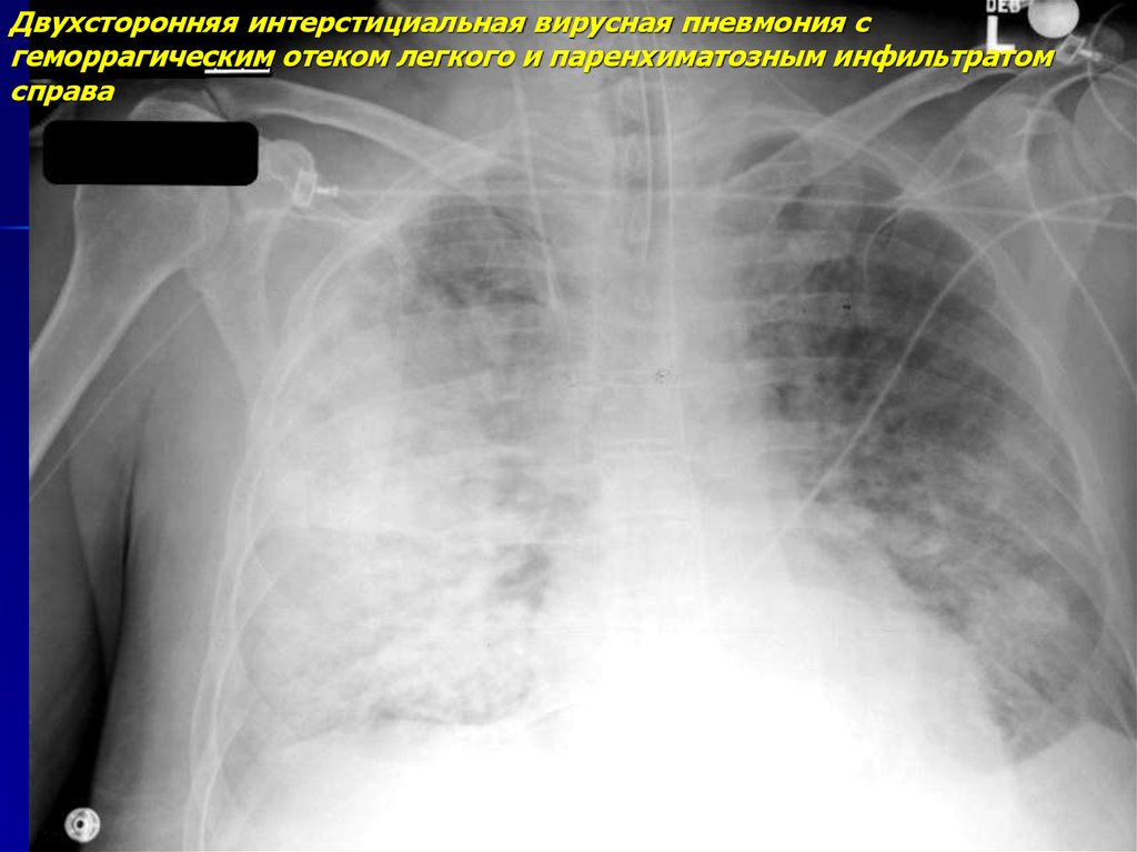 Вирусная пневмония легких. Интерстициальная пневмония рентген. Интерстициальная пневмония пневмония рентген. Отек легкого на рентгенограмме.