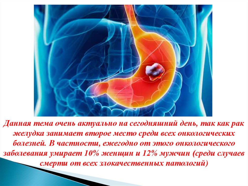 Рак желудка - презентация онлайн