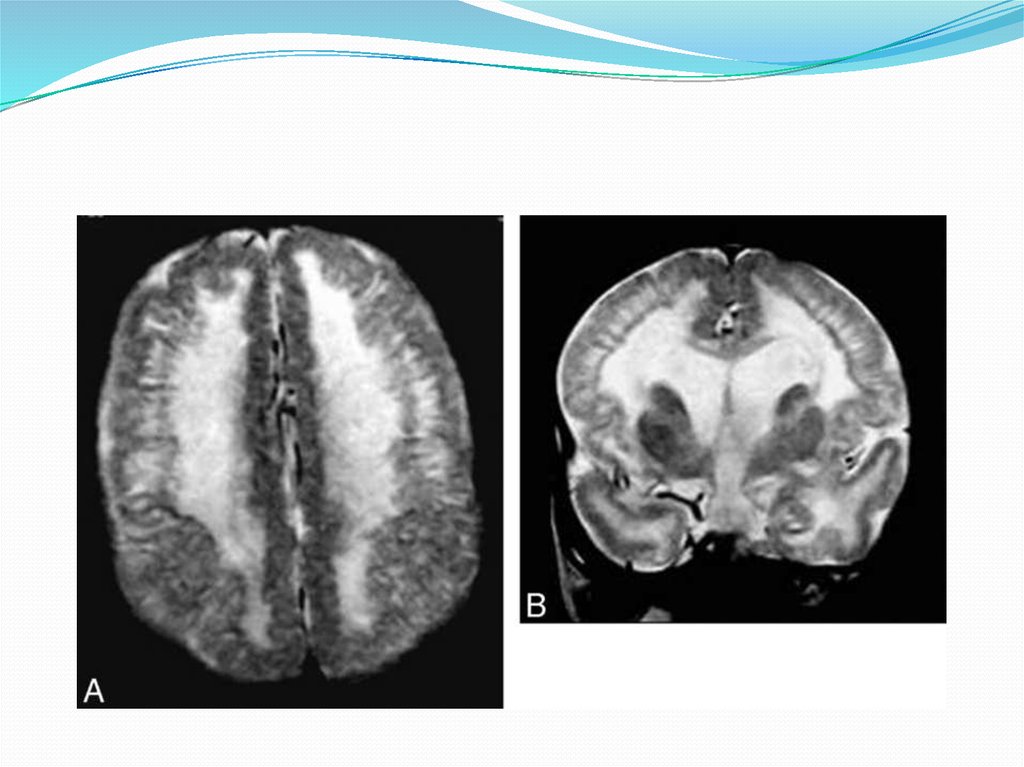 Агенезия венозного. Лиссэнцефалия мрт. Лиссэнцефалия головного мозга у плода. Лиссэнцефалия мрт радиография.