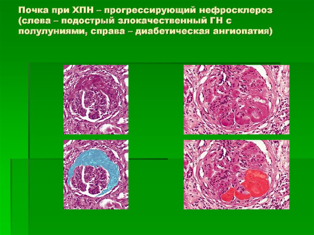 Артериолосклеротический нефросклероз микропрепарат рисунок