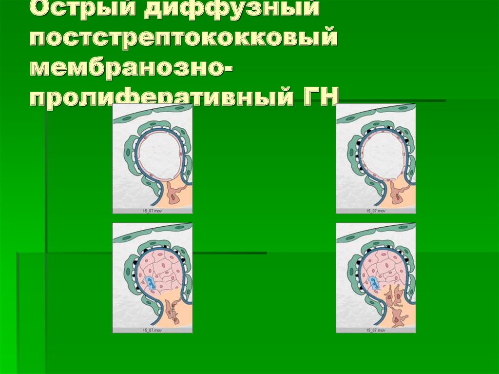Острый диффузный постстрептококковый мембранозно- пролиферативный ГН