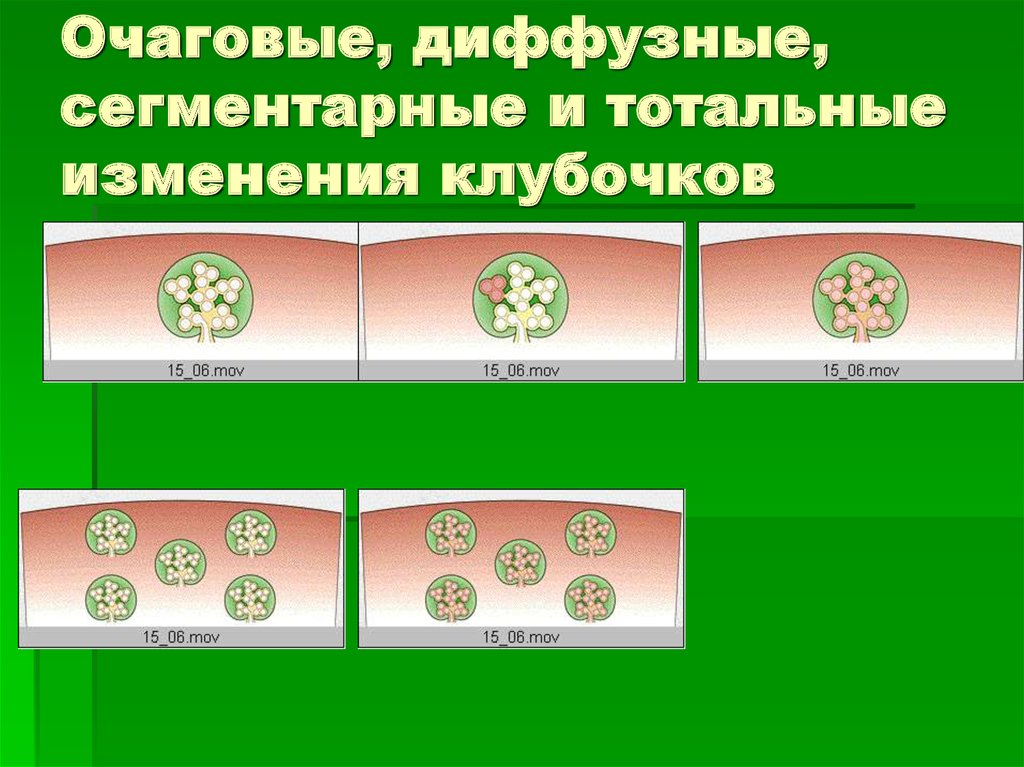 Очаговые, диффузные, сегментарные и тотальные изменения клубочков