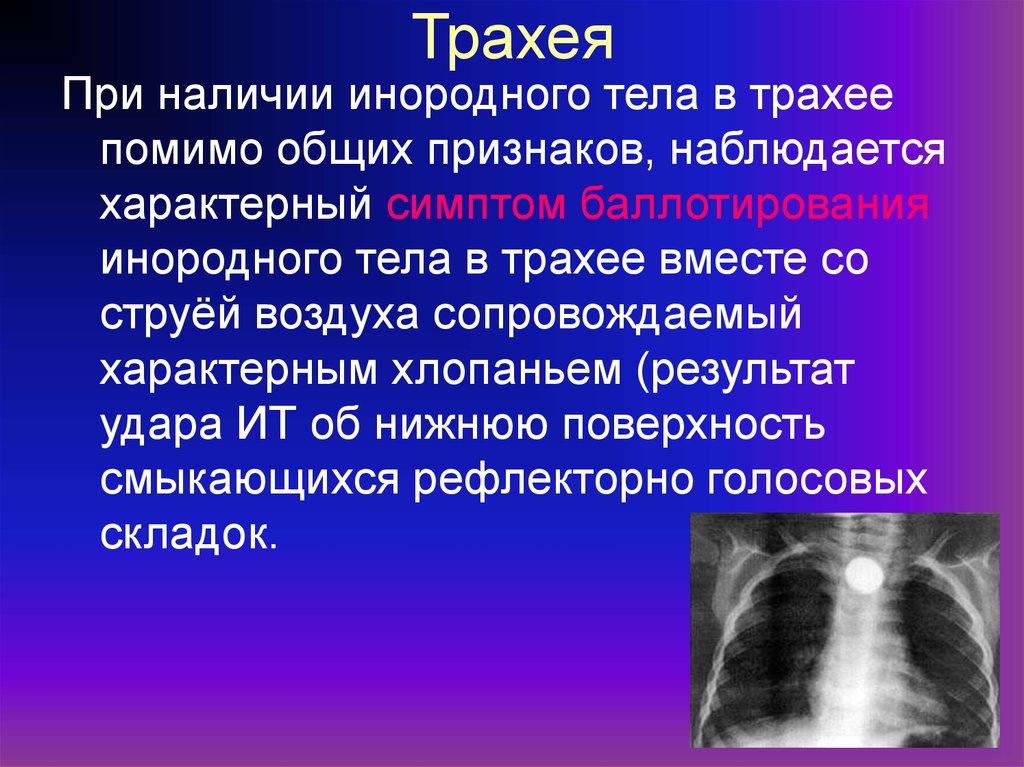 Инородные тела дыхательных путей причины. Симптомы инородного тела. Инородное тело в трахее признаки. Инородные тела дыхательных путей трахеи.