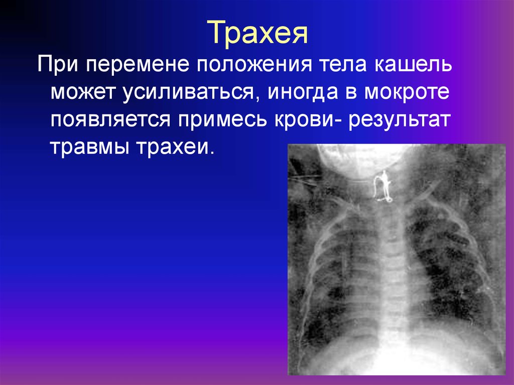 Инородные тела дыхательных путей причины. Инородное тело в трахее рентген. Травматические повреждения трахеи. Инородные тела трахеи и бронхов.