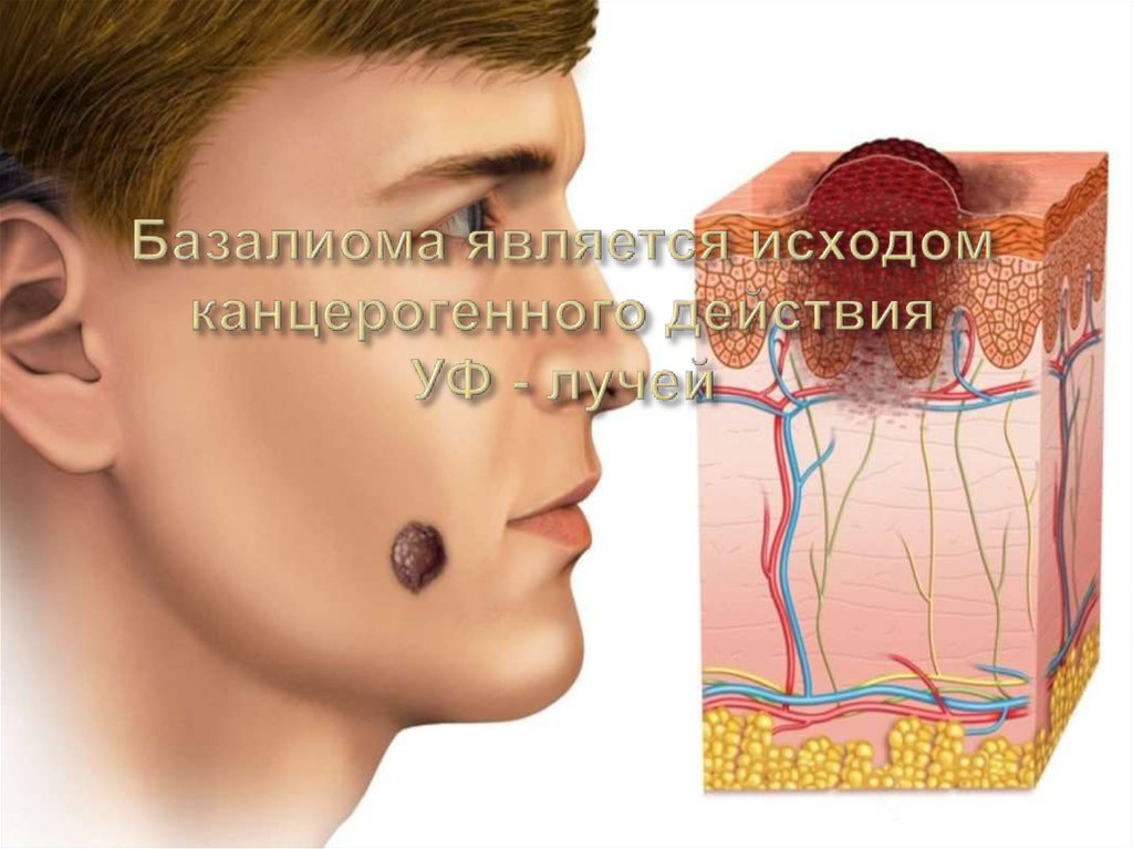 Базалиома является исходом канцерогенного действия УФ - лучей