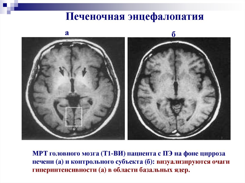 Алкогольная энцефалопатия. Токсико-метаболическая энцефалопатия мрт. Алкогольная энцефалопатия головного мозга на мрт. Печеночная энцефалопатия на кт головной мозг. Кт головного мозга при токсической энцефалопатии.