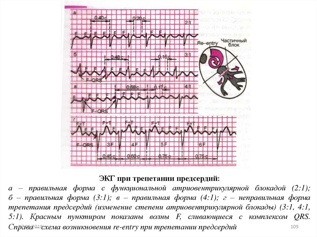 Трепетание предсердий на экг. Трепетание предсердий заключение ЭКГ. Правильная форма трепетания предсердий на ЭКГ. ЭКГ при трепетании предсердий. Трепетание по ЭКГ.