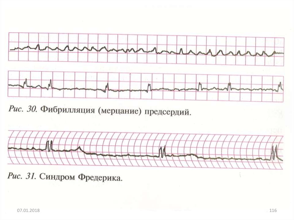 Синдром фредерика на экг фото