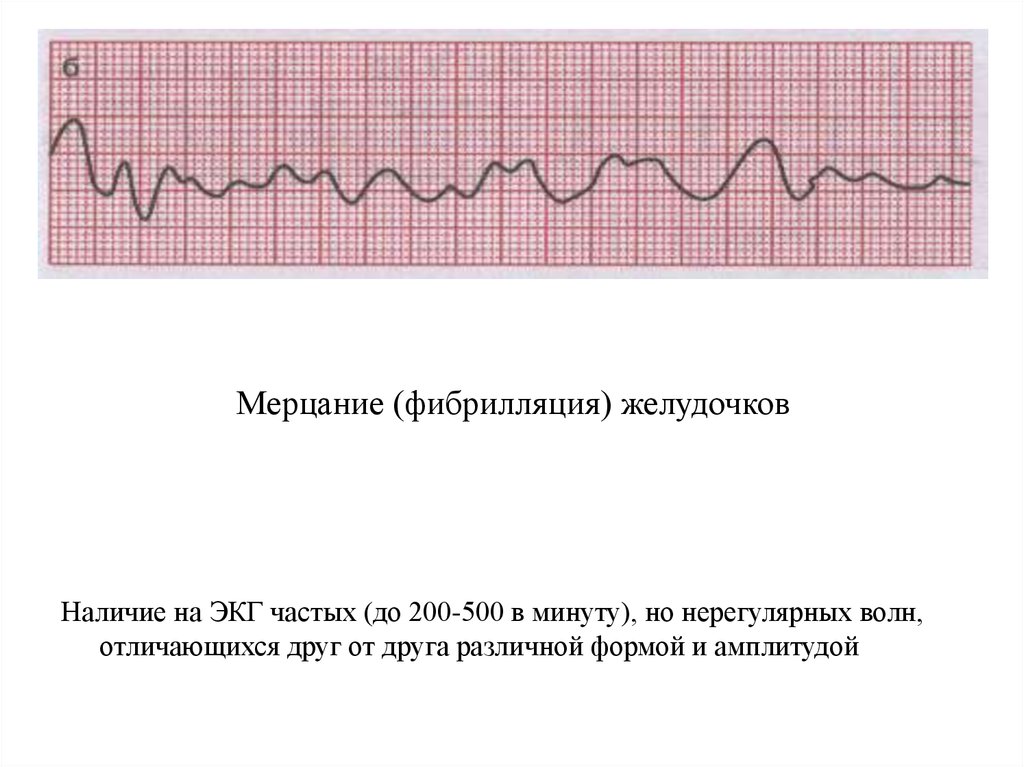 Мерцание на экг. Крупноволновая фибрилляция желудочков на ЭКГ. Мелковолновая фибрилляция желудочков ЭКГ. Фибрилляция желудочков на ЭКГ признаки. Трепетание и фибрилляция желудочков на ЭКГ.