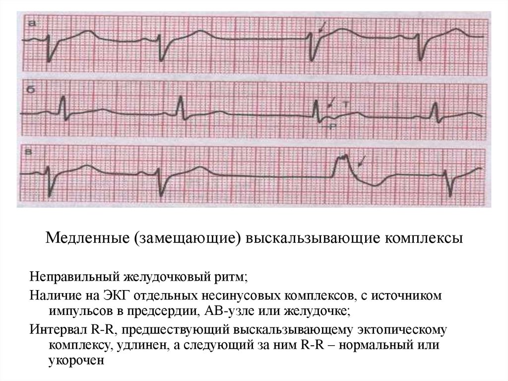 Желудочковый ритм. Медленные выскальзывающие комплексы на ЭКГ. Медленные замещающие выскальзывающие ритмы ЭКГ. Выскальзывающие желудочковые комплексы на ЭКГ. Медленные замещающие выскальзывающие комплексы и ритмы.