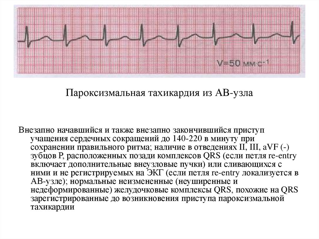 Тахикардия осложнения. Электрокардиограмма сердца при пароксизмальной тахикардии. ЭКГ при пароксизмальной тахикардии. Заключение ЭКГ при пароксизмальной тахикардии. Пароксизмальная синусовая тахикардия.