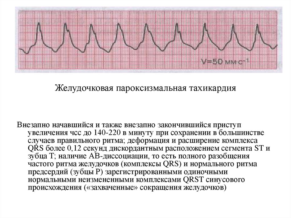 Желудочковый ритм. Пароксизмальная желудочковая тахикардия на ЭКГ. Пароксизм желудочковой тахикардии ЭКГ. Веретенообразная желудочковая тахикардия ЭКГ. ЭКГ признаки пароксизмальной желудочковой тахикардии.