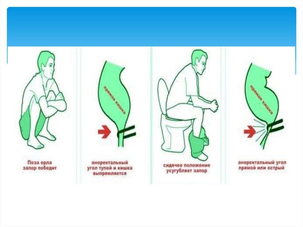 Дефекация при запоре. Поза орла запор победит. Поза орла. Поза при запоре. Поза орла при дефекации.