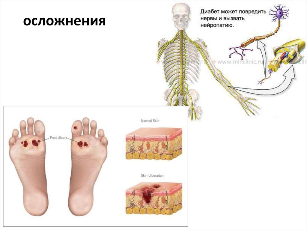 Аксонопатия. Аксонопатии. Последствия нейропатии в картинках. Диабетическая нейропатия стопы. Аксональная нейропатия.