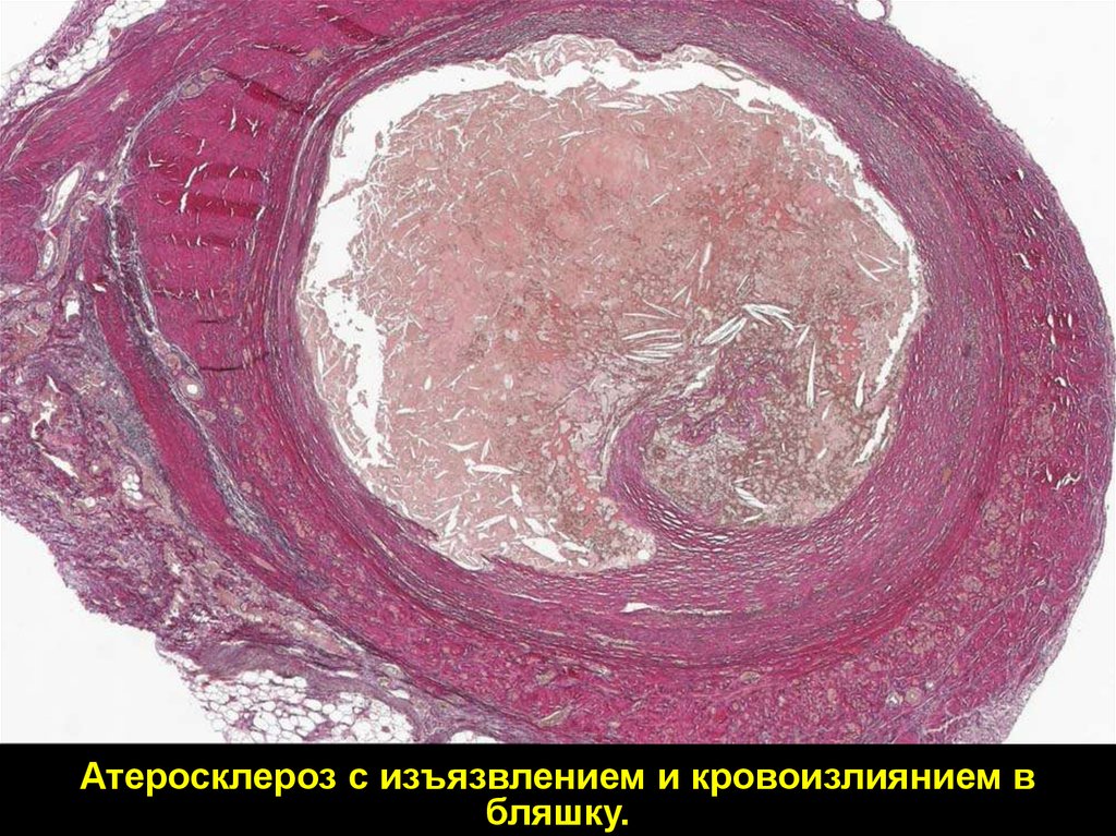 Распад сосудов. Атеросклероз коронарных артерий патанатомия. Атеросклероз аорты гистология. Атеросклероз аорты патанатомия.