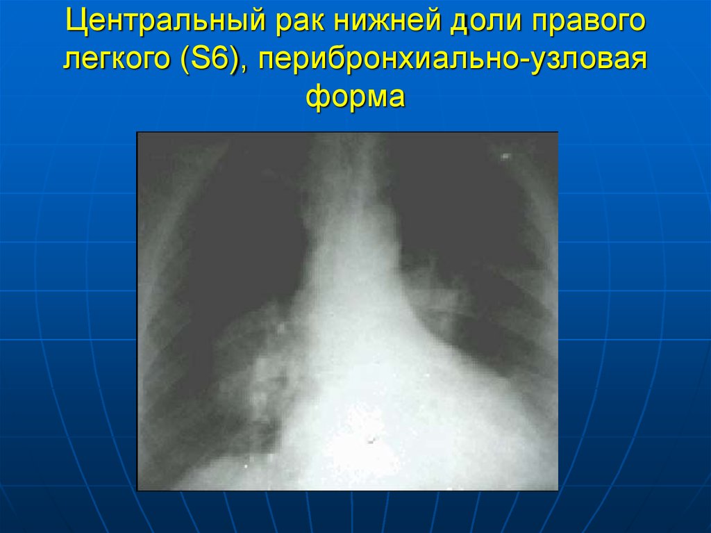 Признаки центрального рака легкого. Центральная опухоль легкого. Перибронхиально Узловая форма. Центральная опухоль правого легкого. Онкология левого легкого.