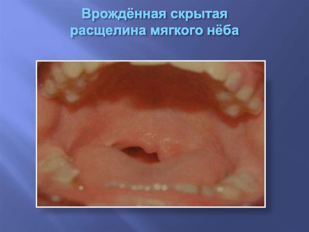 Врождённая скрытая расщелина мягкого нёба